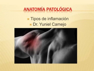 ANATOMÍA PATOLÓGICA
 Tipos de inflamación
 Dr. Yuniel Camejo
 