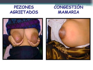 PEZONES     CONGESTIÓN
AGRIETADOS    MAMARIA
 