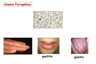 Anemia Ferropénica




                     queilitis   glositis
 
