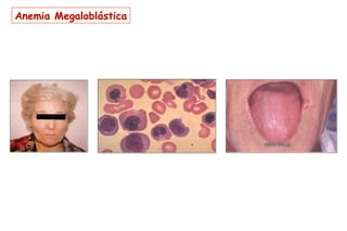 Anemia Megaloblástica
 