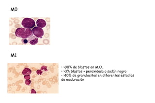 M0




M1

     • >90% de blastos en M.O.
     • >3% blastos + peroxidasa o sudán negro
     • >10% de granulocitos en diferentes estadios
     de maduración
 