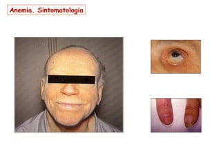 Anemia. Sintomatologia
 