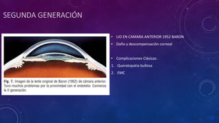 SEGUNDA GENERACIÓN
• LIO EN CAMARA ANTERIOR 1952 BARON
• Daño y descompensación corneal
• Complicaciones Clásicas:
1. Queratopatia bullosa
2. EMC
 
