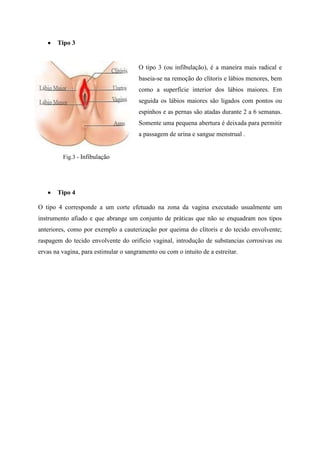 Tipo 3

O tipo 3 (ou infibulação), é a maneira mais radical e
baseia-se na remoção do clítoris e lábios menores, bem
como a superfície interior dos lábios maiores. Em
seguida os lábios maiores são ligados com pontos ou
espinhos e as pernas são atadas durante 2 a 6 semanas.
Somente uma pequena abertura é deixada para permitir
a passagem de urina e sangue menstrual .

Fig.3 - Infibulação

Tipo 4
O tipo 4 corresponde a um corte efetuado na zona da vagina executado usualmente um
instrumento afiado e que abrange um conjunto de práticas que não se enquadram nos tipos
anteriores, como por exemplo a cauterização por queima do clítoris e do tecido envolvente;
raspagem do tecido envolvente do orifício vaginal, introdução de substancias corrosivas ou
ervas na vagina, para estimular o sangramento ou com o intuito de a estreitar.

 