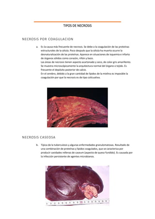 TIPOS DE NECROSIS 
NECROSIS POR COAGULACION 
a. Es la causa más frecuente de necrosis. Se debe a la coagulación de las proteínas estructurales de la célula. Poco después que la célula ha muerto ocurre la desnaturalización de las proteínas. Aparece en situaciones de isquemia e infarto de órganos sólidos como corazón, riñón y bazo. Las áreas de necrosis tienen aspecto acartonado y seco, de color gris amarillento. Se muestra microscópicamente la arquitectura normal del órgano o tejido. Es frecuente el depósito posterior de calcio. En el cerebro, debido a la gran cantidad de lípidos de la mielina es imposible la coagulación por que la necrosis es de tipo colicuativa. 
NECROSIS CASEOSA 
b. Típica de la tuberculosis y algunas enfermedades granulomatosas. Resultado de una combinación de proteínas y lípidos coagulados, que se caracteriza por producir cavidades rellenas de caseum (aspecto de queso fundido). Es causada por la infección persistente de agentes microbianos. 
 