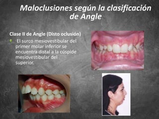 Clase II de Angle (Disto oclusión)
El surco mesiovestibular del
primer molar inferior se
encuentra distal a la cúspide
mesiovestibular del
superior.
Maloclusiones según la clasificación
de Angle
 