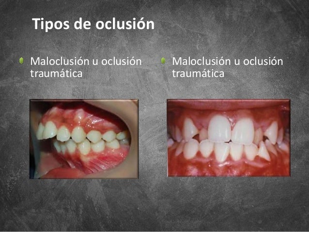 Tipos de oclusión