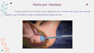 Parto por Ventosa
O parto distócico por ventosa visa a aplicação de um sistema de vácuo, por pressão
negativa, que faz flexão e tração na apresentação cefálica do feto.
 