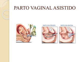 PARTO VAGINAL ASISTIDO
 