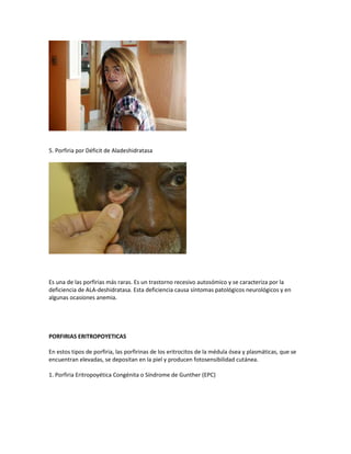 5. Porfiria por Déficit de Aladeshidratasa




Es una de las porfirias más raras. Es un trastorno recesivo autosómico y se caracteriza por la
deficiencia de ALA-deshidratasa. Esta deficiencia causa síntomas patológicos neurológicos y en
algunas ocasiones anemia.




PORFIRIAS ERITROPOYETICAS

En estos tipos de porfiria, las porfirinas de los eritrocitos de la médula ósea y plasmáticas, que se
encuentran elevadas, se depositan en la piel y producen fotosensibilidad cutánea.

1. Porfiria Eritropoyética Congénita o Síndrome de Gunther (EPC)
 