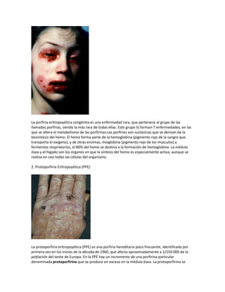 La porfiria eritropoyética congénita es una enfermedad rara, que pertenece al grupo de las
llamadas porfirias, siendo la más rara de todas ellas. Este grupo lo forman 7 enfermedades, en las
que se altera el metabolismo de las porfirinas.Las porfirias son sustancias que se derivan de la
biosíntesis del hemo. El hemo forma parte de la hemoglobina (pigmento rojo de la sangre que
transporta el oxígeno), y de otras enzimas, mioglobina (pigmento rojo de los músculos) y
fermentos respiratorios, el 80% del hemo se destina a la formación de hemoglobina. La médula
ósea y el hígado son los órganos en que la síntesis del hemo es especialmente activa, aunque se
realiza en casi todas las células del organismo.

2. Protoporfiria Eritropoyética (PPE)




La protoporfiria eritropoyética (PPE) es una porfiria hereditaria poco frecuente, identificada por
primera vez en los inicios de la década de 1960, que afecta aproximadamente a 1/150 000 de la
población del oeste de Europa. En la PPE hay un incremento de una porfirina particular
denominada protoporfirina que se produce en exceso en la médula ósea. La protoporfirina se
 