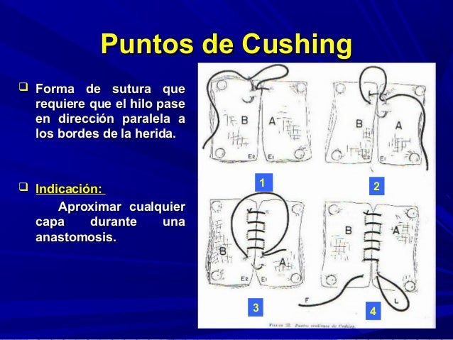 Tipos de puntos , nudos y suturas