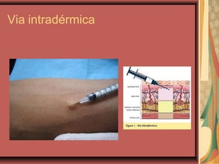Via intradérmica
 