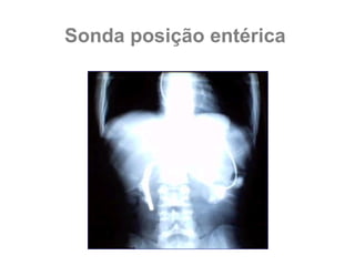 Sonda posição entérica
 