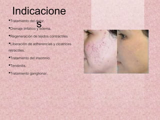 Indicacione 
s •Tratamiento del dolor. 
•Drenaje linfático y edema. 
•Regeneración de tejidos contráctiles 
•Liberación de adherencias y cicatrices 
retractiles. 
•Tratamiento del insomnio. 
•Tendinitis. 
•Tratamiento ganglionar. 
 
