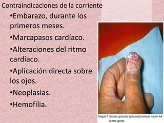 Contraindicaciones de la corriente 
•Embarazo, durante los 
primeros meses. 
•Marcapasos cardíaco. 
•Alteraciones del ritmo 
cardíaco. 
•Aplicación directa sobre 
los ojos. 
•Neoplasias. 
•Hemofilia. 
