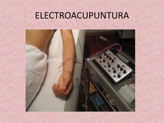 ELECTROACUPUNTURA 
 