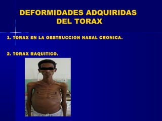 DEFORMIDADES ADQUIRIDAS
DEL TORAX
1. TORAX EN LA OBSTRUCCION NASAL CRONICA.
2. TORAX RAQUITICO.