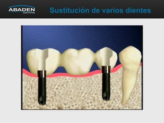 Sustitución de varios dientes
 