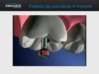 Prótesis fija atornillada al implante
 