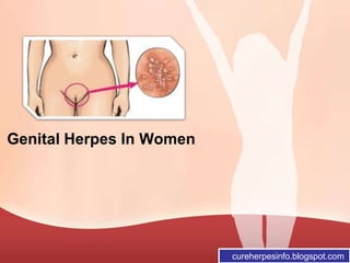 Genital Herpes In Women
cureherpesinfo.blogspot.com
 