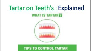 Tartar on Teeth’s : Explained
 