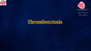 Thrombocytosis
Tips & Tricks in
CBC reading
 Thrombocytosis (> 450,000)
 Mild > 500,000 Moderate > 700,000
 Severe > 90...