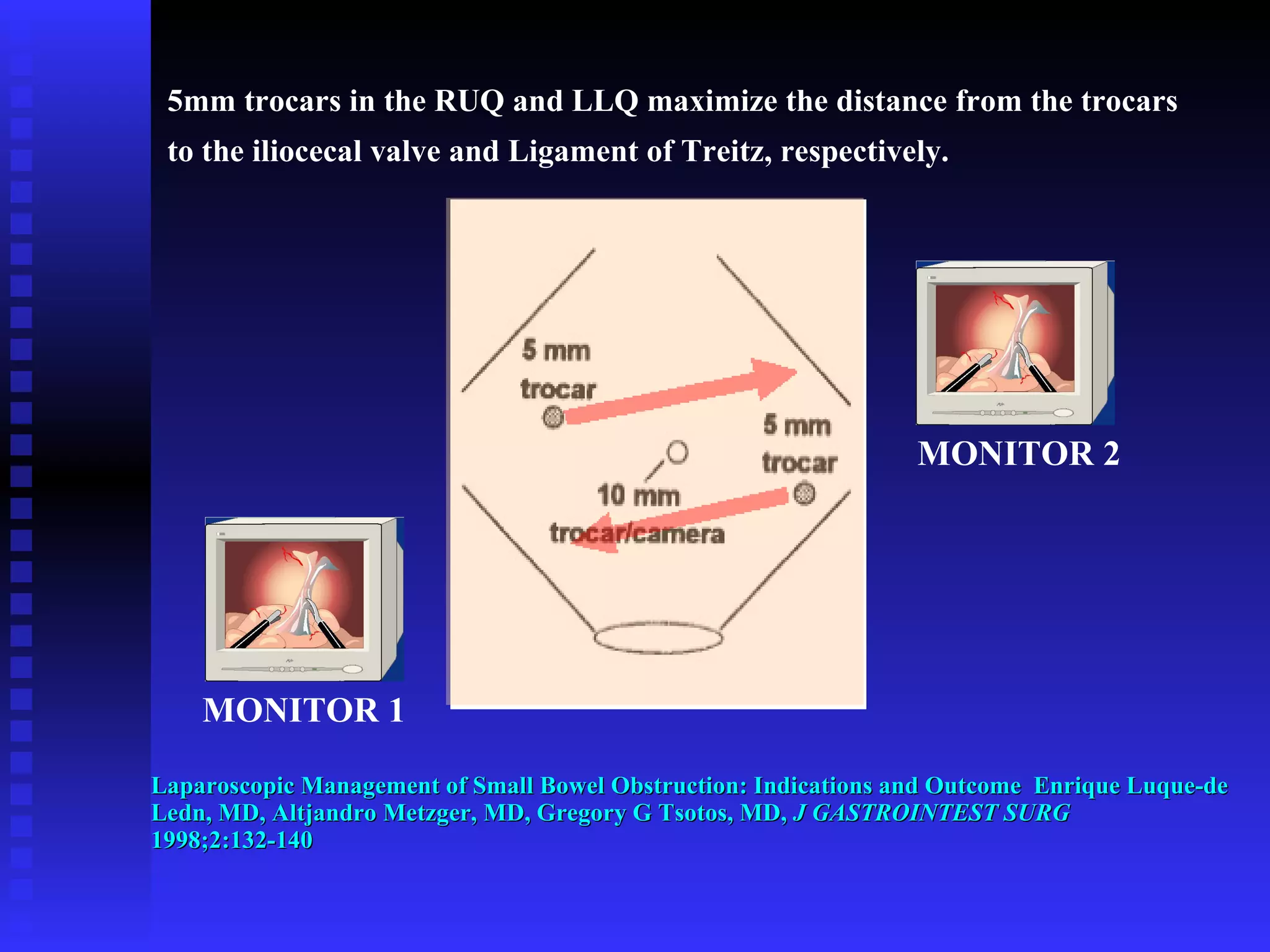 Laparoscopic Management of Small Bowel Obstruction: Indications and Outcome  Enrique Luque-de Ledn, MD, Altjandro Metzger, MD, Gregory G Tsotos, MD,  J GASTROINTEST SURG  1998;2:132-140 5mm trocars in the RUQ and LLQ maximize the distance from the trocars  to the iliocecal valve and Ligament of Treitz, respectively. MONITOR 1 MONITOR 2 
