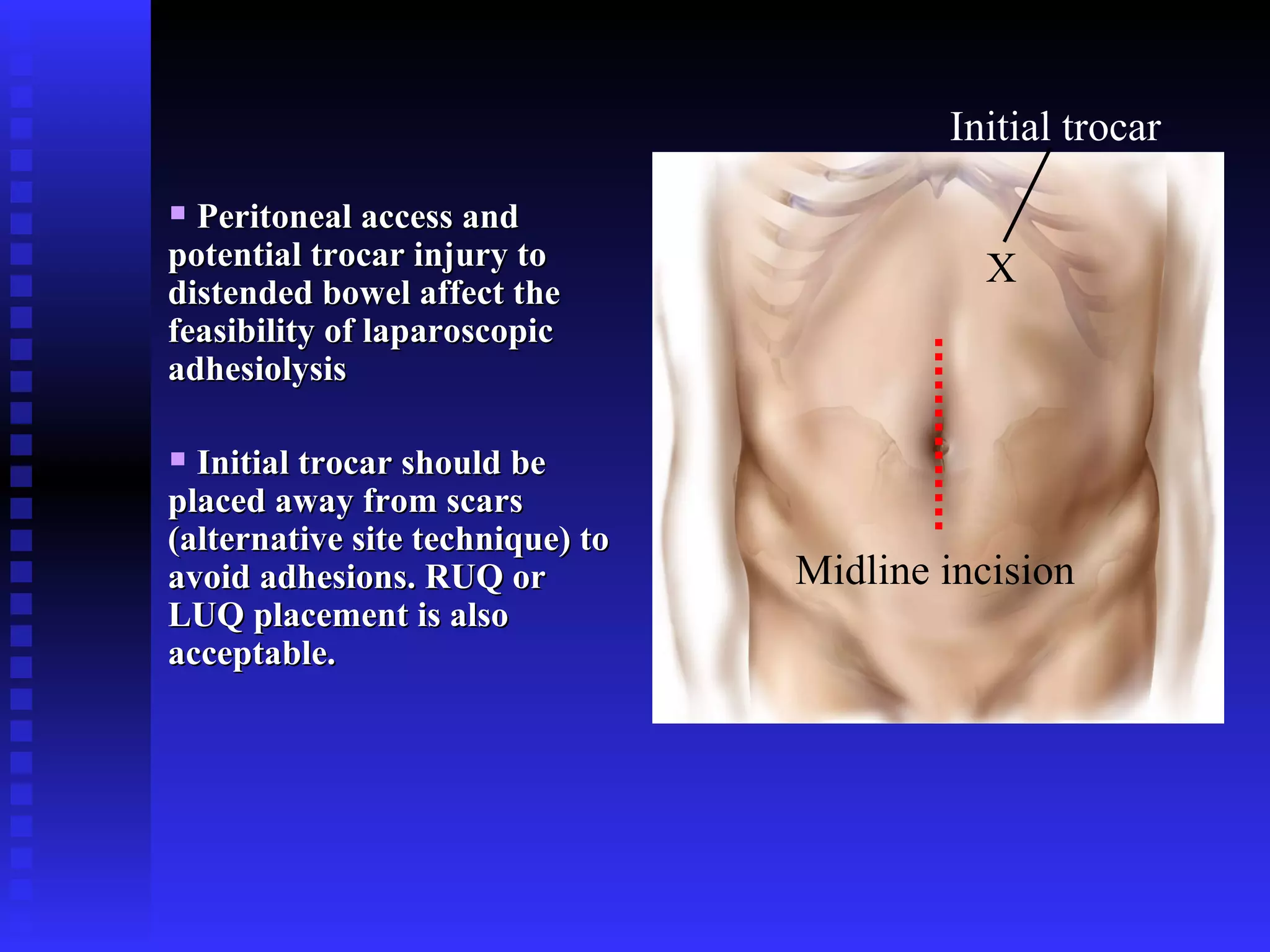 Peritoneal access and potential trocar injury to distended bowel affect the feasibility of laparoscopic adhesiolysis Initial trocar should be placed away from scars (alternative site technique) to avoid adhesions. RUQ or LUQ placement is also acceptable. Midline incision Initial trocar X 