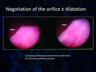 Negotiation of the orifice ± dilatation
Cystoscopy showing protuberance at the level
of Left vesico ureteric junction
 