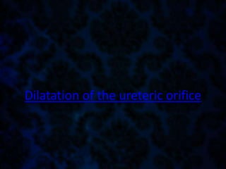 Dilatation of the ureteric orifice
 