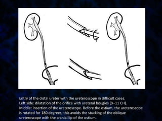 Entry of the distal ureter with the ureteroscope in difficult cases:
Left side: dilatation of the orifice with ureteral bougies (9–11 CH).
Middle: insertion of the ureteroscope. Before the ostium, the ureteroscope
is rotated for 180 degrees, this avoids the stucking of the oblique
ureteroscope with the cranial lip of the ostium.
 