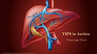 TIPS in Ascites
Pratap Sagar Tiwari
Pic ref: https://www.sehatq.com/tindakan-medis/transjugular-intrahepatic-portosystemic-shunt-tips
 