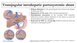 Transjugular intrahepatic portosystemic shunt
©2018 UpToDate
• Balloon dilatation of the parenchymal tract between the hepatic
(or IVC) and PVs.
• Deployment of the stent within the parenchymal tract.
• Hemodynamic assessment of the resultant PPG reduction
followed by further balloon dilatation of the lumen to reach the
desired target of pressure gradient.
• Reduction of PPG to <12 mm Hg should be achieved when the
indication is bleeding from EV.
S. Fagiuoli, R. Bruno, and V. W. Debernardi, “Consensus conference on TIPS management: Techniques, indications, contraindications,”
Digestive and Liver Disease, vol. 49, no. 2, pp. 121–137, 2017. 12
 