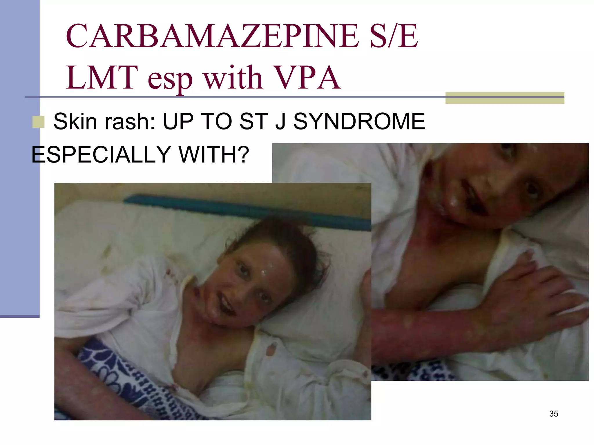 35
CARBAMAZEPINE S/E
LMT esp with VPA
 Skin rash: UP TO ST J SYNDROME
ESPECIALLY WITH?
 