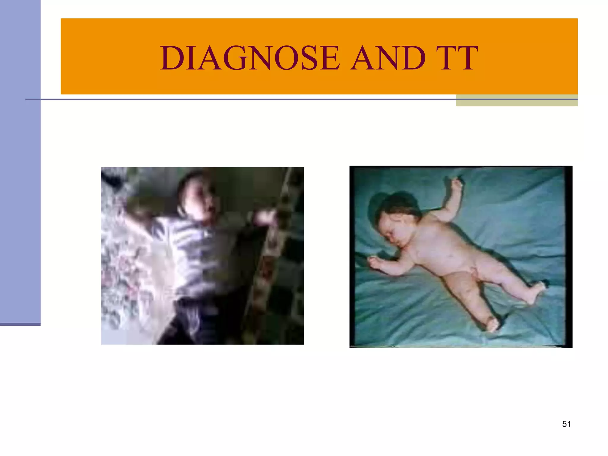 51
DIAGNOSE AND TT
 