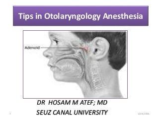 Tips in Otolaryngology Anesthesia
DR HOSAM M ATEF; MD
SEUZ CANAL UNIVERSITY 2/24/20161
 
