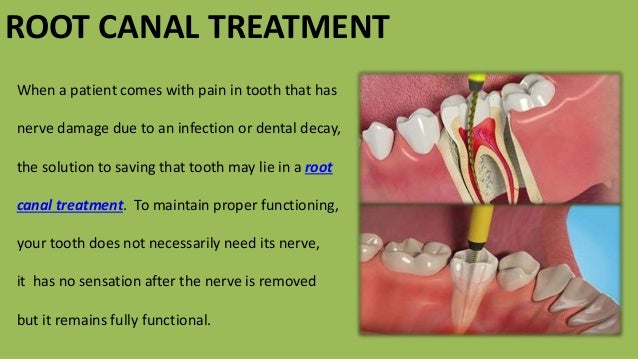 Tips to follow after Root Canal Treatment