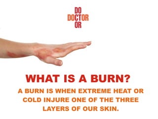 A BURN IS WHEN EXTREME HEAT OR
COLD INJURE ONE OF THE THREE
LAYERS OF OUR SKIN.
WHAT IS A BURN?
 