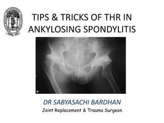 TIPS & TRICKS OF THR IN
ANKYLOSING SPONDYLITIS
DR SABYASACHI BARDHAN
Joint Replacement & Trauma Surgeon
 