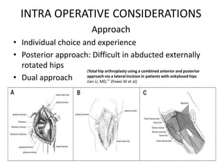 Moore Approach Tips & tricks of Total Hip arthroplasty in ankylosing spondylitis | PPTX