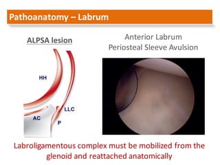 Arthroscopic management of anterior shoulder instability larissa 2016 | PDF