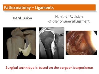 Pathoanatomy – Ligaments		
Humeral	Avulsion
of	Glenohumeral Ligament
Surgical	technique	is	based	on	the	surgeon’s	experien...