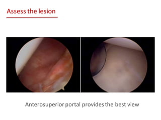Prepare	the	lesion
• Dissect	the	capsulolabral
sleeve	from	the	anterior	
glenoid	neck
• Rasp	the	anterior	glenoid	to	
crea...