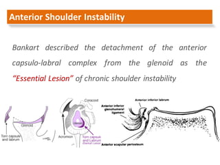 Anterior	Shoulder	Instability
Bankart described the detachment of the anterior
capsulo-labral complex from the glenoid as ...