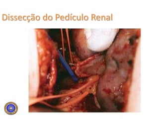 Avaliação Pré-operatóriaTomografia computadorizada (TC)  idealmente com angiotomografia e reconstruçãoAvaliação torácicaRX simples abdome ou TC Tórax