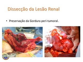 Posicionamento e IncisãoDepende da preferência do Cirurgião e localização da lesão, devendo permitir ampla exposição e abordagem do pedículo renal.