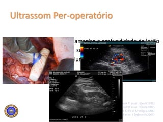 Posicionamento e IncisãoMini –Lombotomia11º espaço intercostal3 cm da ponta da 11ª costela, sem sua ressecção7 a 9 cm