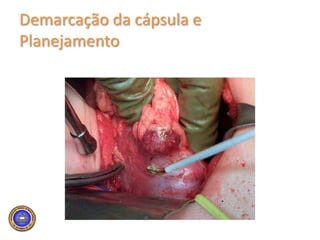 Lesões pequenas, periféricas, de fácil resecção