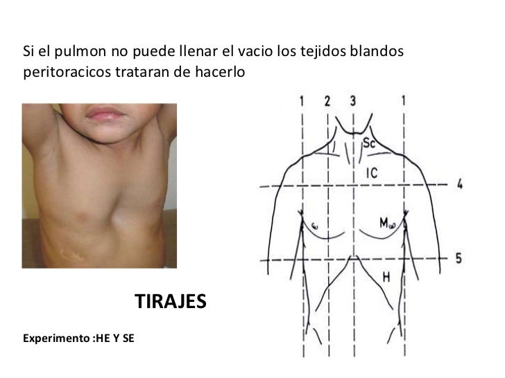 Tiraje tiraje